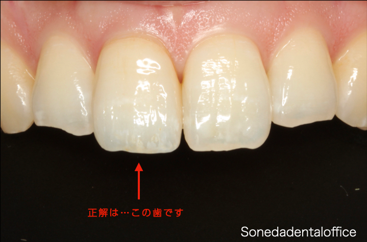 歯の症例写真